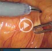 Off-clamp robotic-assisted partial nephrectomy
