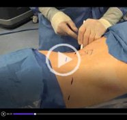 Retroperitoneal access for robotic renal surgery