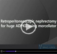 Retroperitoneoscopic nephrectomy for huge autosomal-dominant polycystic kidney disease using morcellator