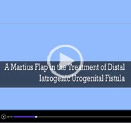 A martius flap in the treatment of iatrogenic distal urogenital fistula