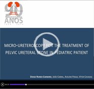 Micro-ureteroscopy for treatment of pelvic ureteral stone in pediatric patient