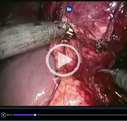 Robot assisted radical nephrectomy + hysterectomy and specimen retrieval per vaginum (NOSE)