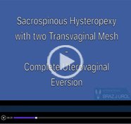 Sacrospinous hysteropexy with a low weight transvaginal polypropylene mesh for treatment of complete uterovaginal eversion