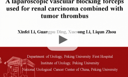 A laparoscopic vascular blocking forceps used for renal carcinoma combined with tumor thrombus