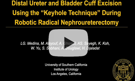 Distal ureter and bladder cuff excision using the “Keyhole Technique” during Robotic Radical Nephroureterectomy