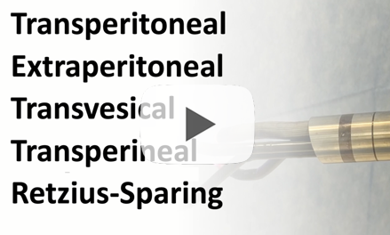 Da Vinci SP radical prostatectomy: a multicentric collaboration and step-by-step techniques