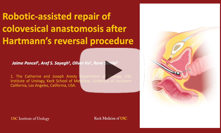 Robotic-assisted repair of colovesical anastomosis after Hartmann’s reversal procedure