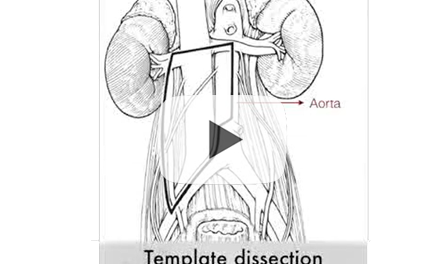Primary laparoscopic RPLND for pure seminona metastasis: feasibility of supine and lateral approaches