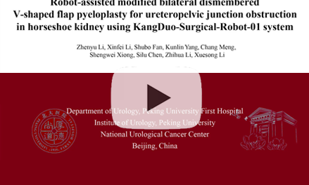 Robot-assisted modified bilateral dismembered V-shaped flap pyeloplasty for ureteropelvic junction obstruction in horseshoe kidney using KangDuo-Surgical-Robot-01 system