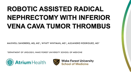 Robotic assisted radical nephrectomy with Inferior vena cava tumor thrombus