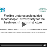 Flexible Ureteroscopic Guided Laparoscopic Ureteroplasty For The Treatment Of Ureteral Stricture