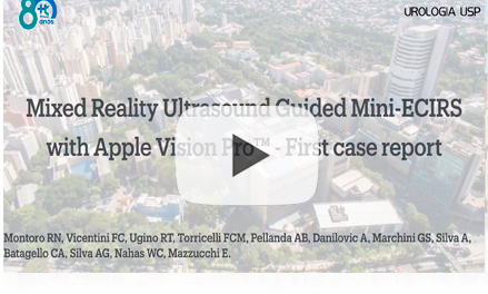 Mixed Reality Ultrasound-Guided Mini-ECIRS with Apple Vision Pro™ – First Case Report