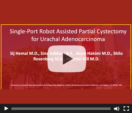 Single-Port Robot assisted partial cystectomy for urachal adenocarcinoma