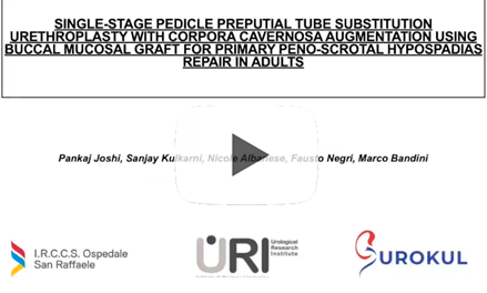Single-Stage Pedicle Preputial Tube Substitution Urethroplasty with Corpora Cavernosa Augmentation Using Buccal Mucosa Graft for Primary Peno-Scrotal Hypospadias Repair in Adults