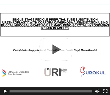 Single-Stage Pedicle Preputial Tube Substitution Urethroplasty with Corpora Cavernosa Augmentation Using Buccal Mucosa Graft for Primary Peno-Scrotal Hypospadias Repair in Adults