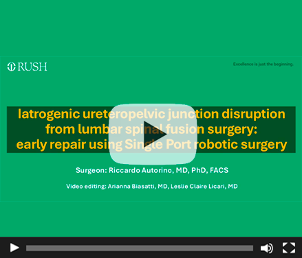 Iatrogenic Ureteropelvic Junction Disruption from Lumbar Spinal Fusion Surgery: Early Repair using The SP Robotic System