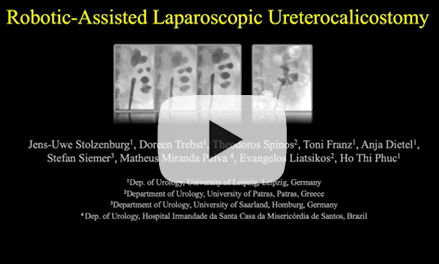Robotic-assisted Laparoscopic Ureterocalicostomy (RALUC): How we do it