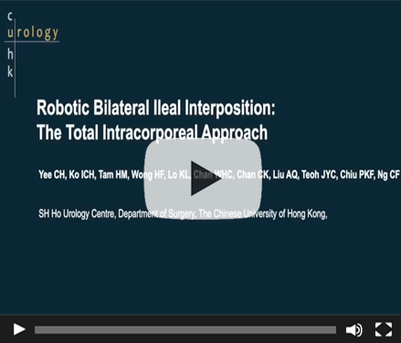 Robotic Bilateral Ileal Interposition: The Total Intracorporeal Approach