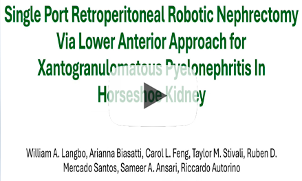 SP Retroperitoneal Robotic Nephrectomy via Lower Anterior Approach for Xanthogranulomatous Pyelonephritis in a Horseshoe Kidney