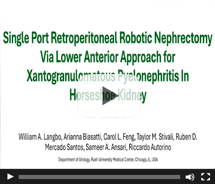 SP Retroperitoneal Robotic Nephrectomy via Lower Anterior Approach for Xanthogranulomatous Pyelonephritis in a Horseshoe Kidney