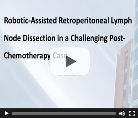 Robotic-Assisted Retroperitoneal Lymph Node Dissection in a Challenging Post-Chemotherapy Case