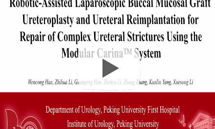 Robotic-Assisted Laparoscopic Buccal Mucosal Graft Ureteroplasty and Ureteral Reimplantation for Repair of Complex Ureteral Strictures Using the Modular Carina™ System