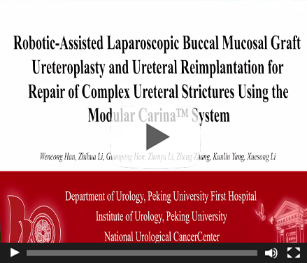 Robotic-Assisted Laparoscopic Buccal Mucosal Graft Ureteroplasty and Ureteral Reimplantation for Repair of Complex Ureteral Strictures Using the Modular Carina™ System